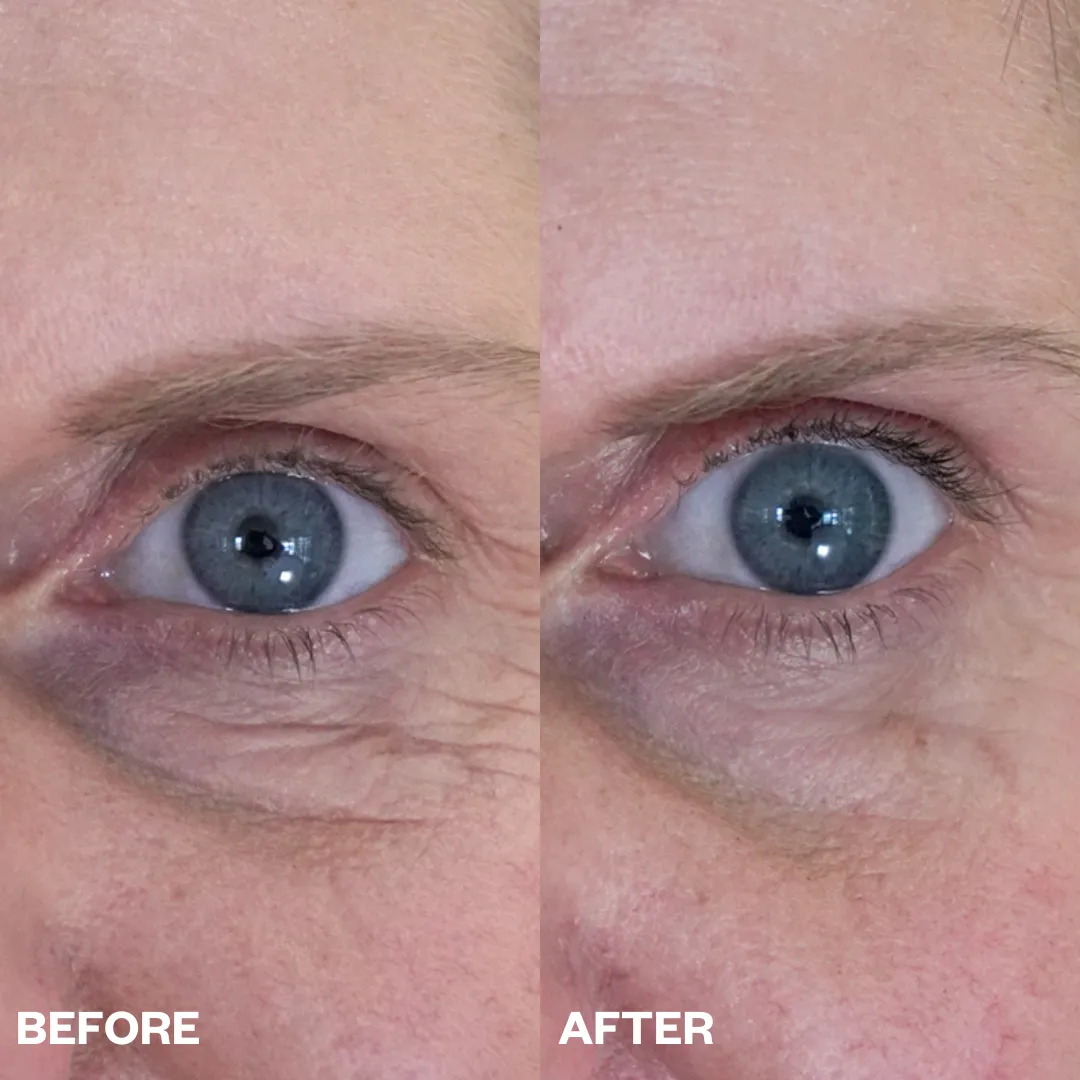Eye Wrinkle Patches