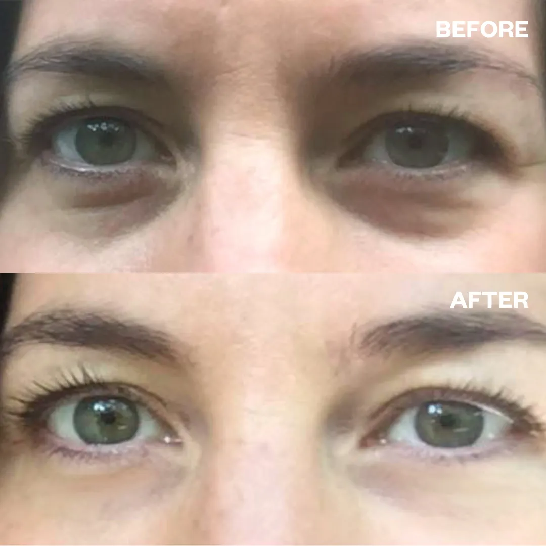 Eye Wrinkle Patches